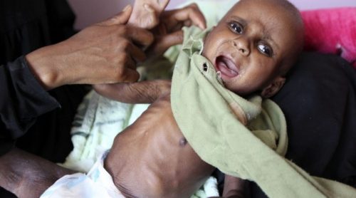 सोमालिया, इथियोपिया र केन्याका ७० लाख बालबालिकामा कुपोषण