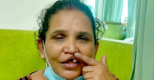 पित्तथैलीको अप्रेसन गर्दा तीनवटा दाँत गायव