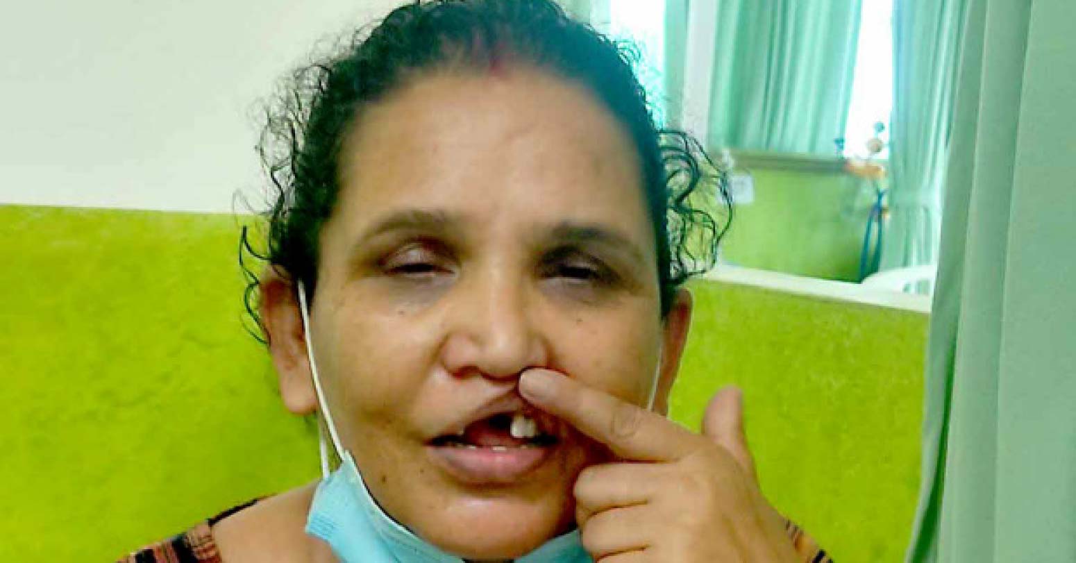 पित्तथैलीको अप्रेसन गर्दा तीनवटा दाँत गायव